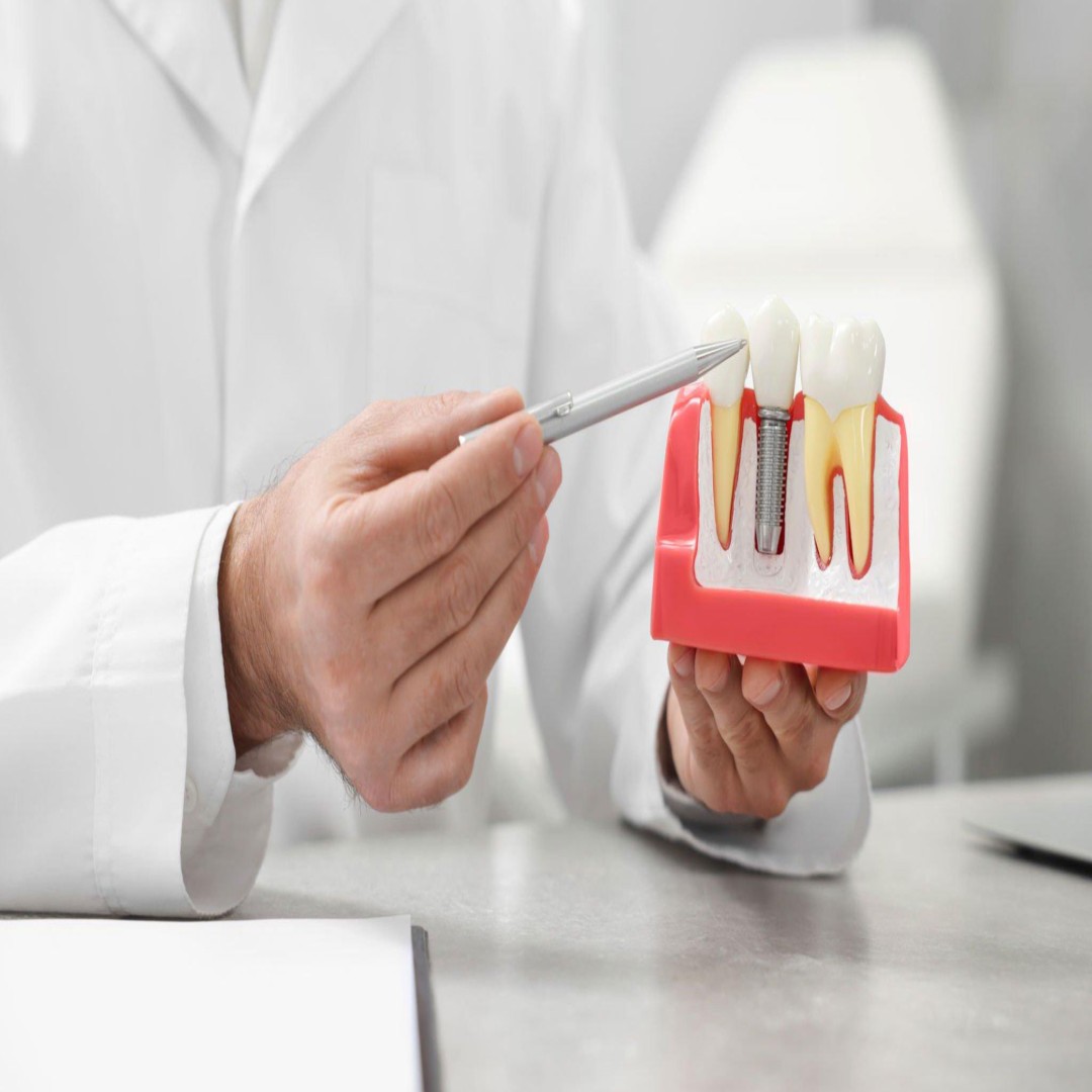 Diş Protezleri: Sabit ve Hareketli Protez Çeşitleri | 